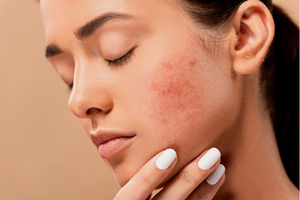 Marula Oil for Acne - Is it bad for oily skin? 