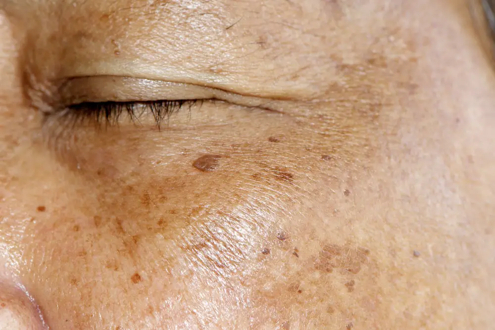 What is Hyperpigmentation